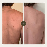 30 Day Miracle Acne Cleanser
