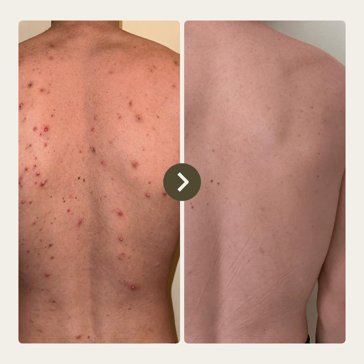 Dermalabs ActiveClear - טיפול באקנה גוף תוך 30 יום
