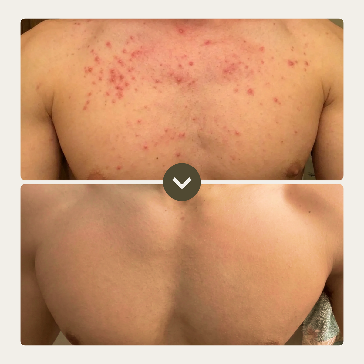 Dermalabs ActiveClear - טיפול באקנה גוף תוך 30 יום